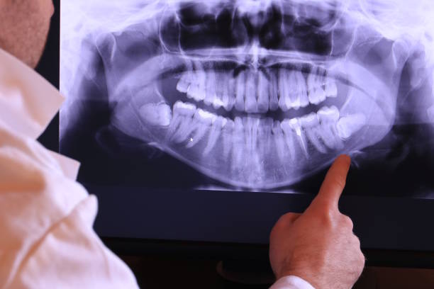 Best Emergency Dentist for Lost Fillings or Crowns in Brookside, NJ